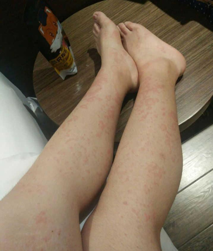 个人湿疹症状——红疹密密麻麻,发痒严重,大片溃烂!
