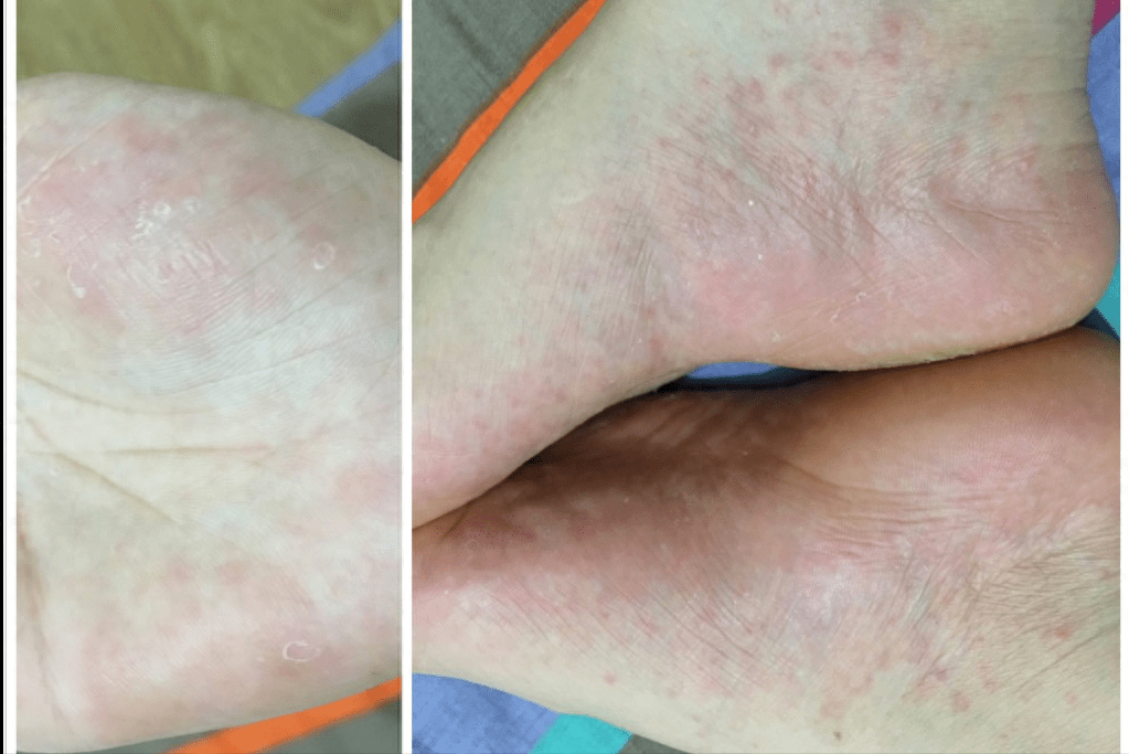 第一内服缓解药相信很多宝子跟我一样,只要体内湿气加重,就会出湿疹