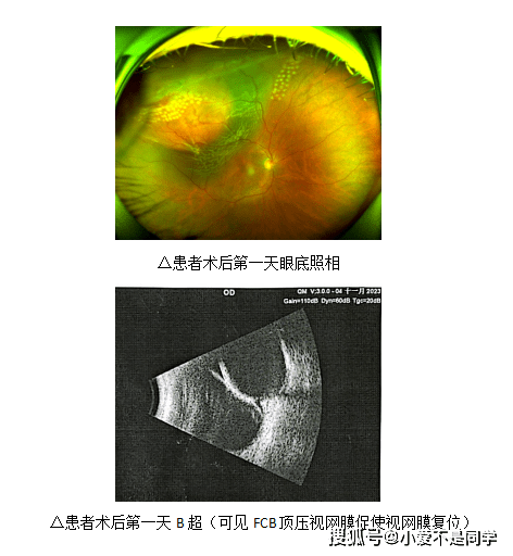 深圳愛爾完成深圳首例摺疊頂壓球囊(fcb)手術_視網膜_患者_加壓