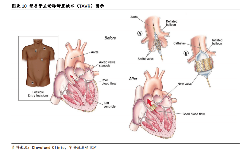 深度 | 心脏瓣膜医疗器械分析报告(启明医疗篇)