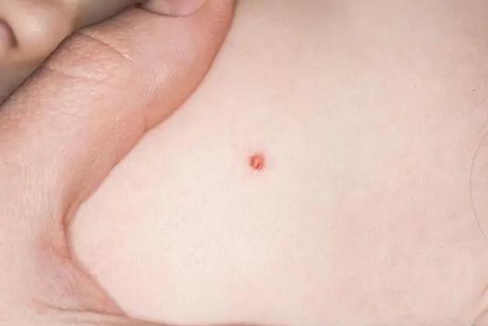 脖子,腋下出现的"小肉粒",是什么?对健康有没有影响?