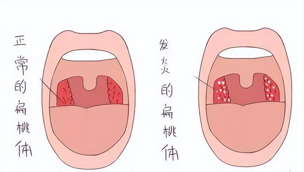 其他因素 长期喉咙感染