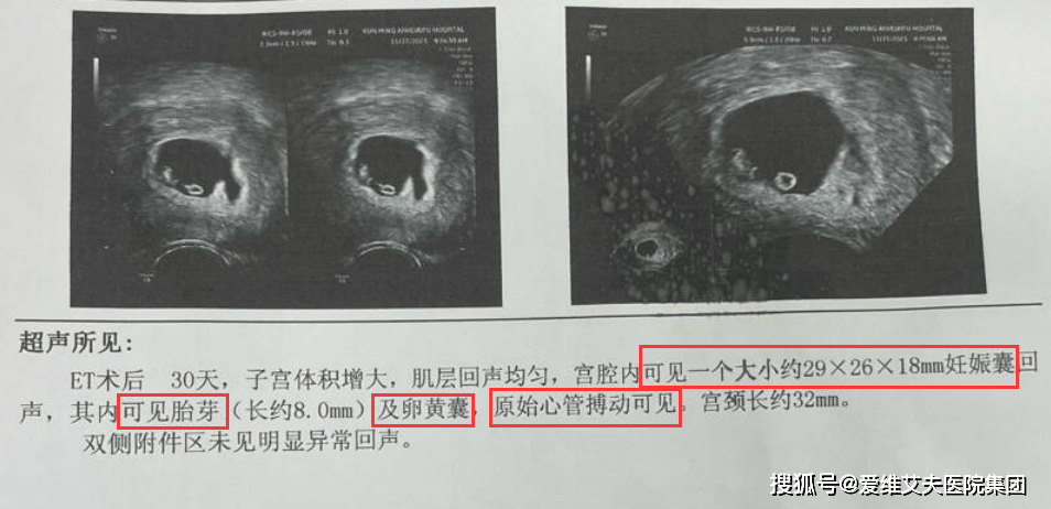 經陰道超聲檢查孕囊平均直徑>20mm,胎芽>5mm,並可見胎心搏動,即為正常