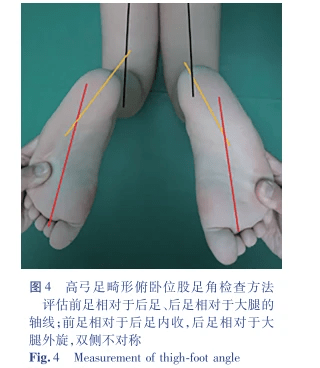 北京大榮診所胡霞:兒童高弓足畸形的臨床評估方法_患兒_檢查_下關