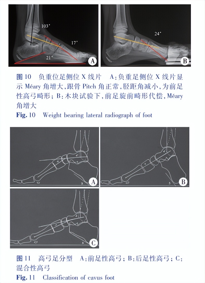 北京大榮診所足踝醫生胡霞:兒童高弓足畸形的影像學評估_縱軸_脛骨