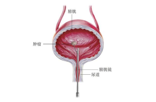 肾与膀胱连接图图片