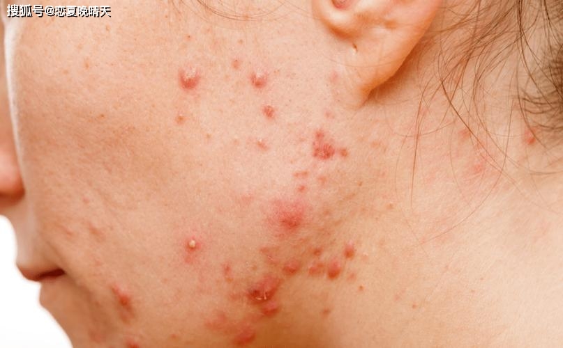 红斑狼疮致残致死率较高_治疗_患者_系统性