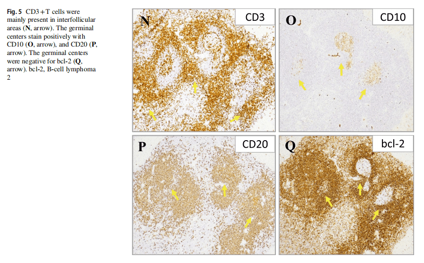 免疫組化檢查顯示cd3,cd10(生髮中心)和cd20陽性,b細胞淋巴瘤2(bcl-2)