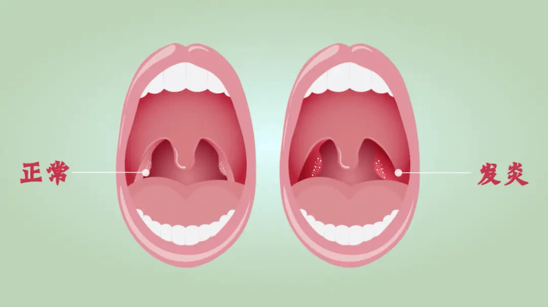 由于扁桃体的位置特殊,呼吸和饮食都是通过口咽部,使得它容易受到细菌