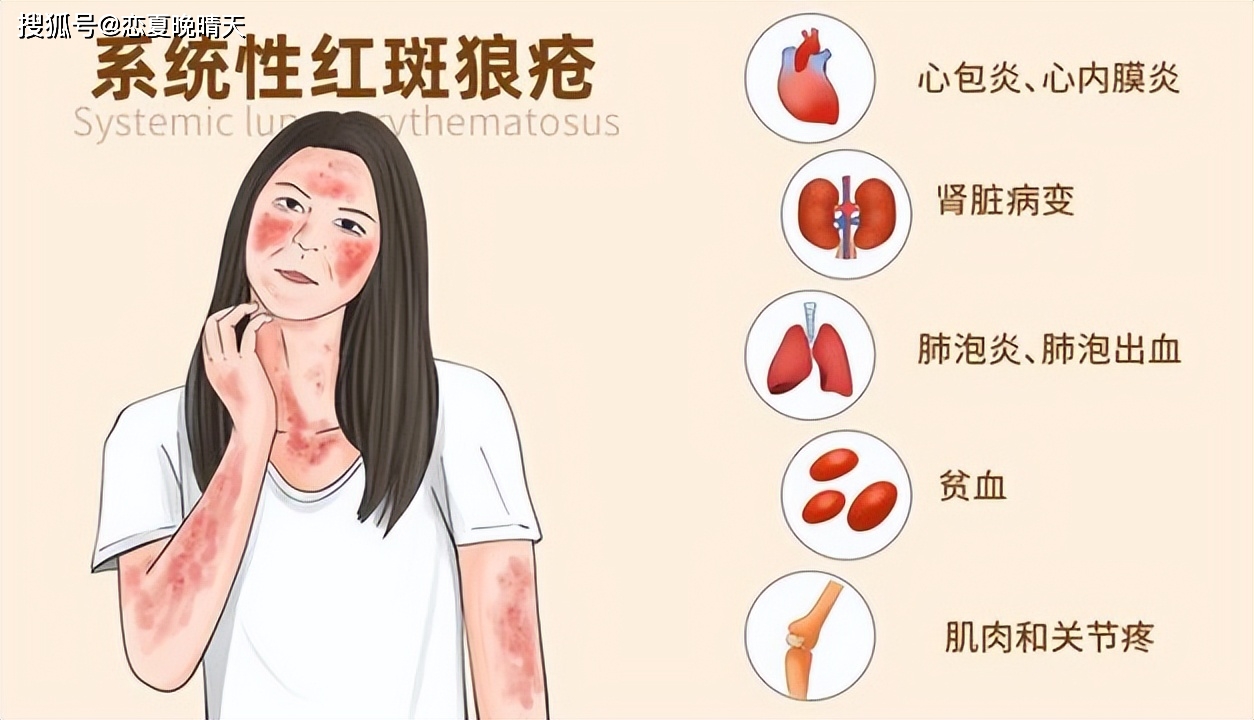 红斑狼疮十大禁忌图片