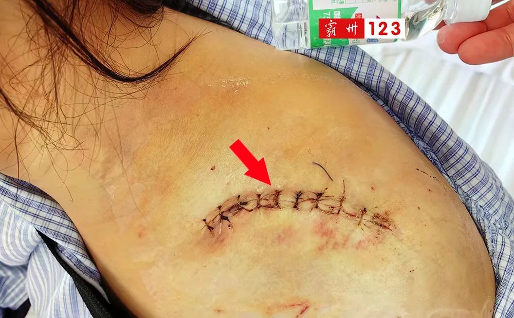 霸州女子洗澡被砸骨折,脱落淋浴门赔偿成纠纷_张女士_品牌_诊断