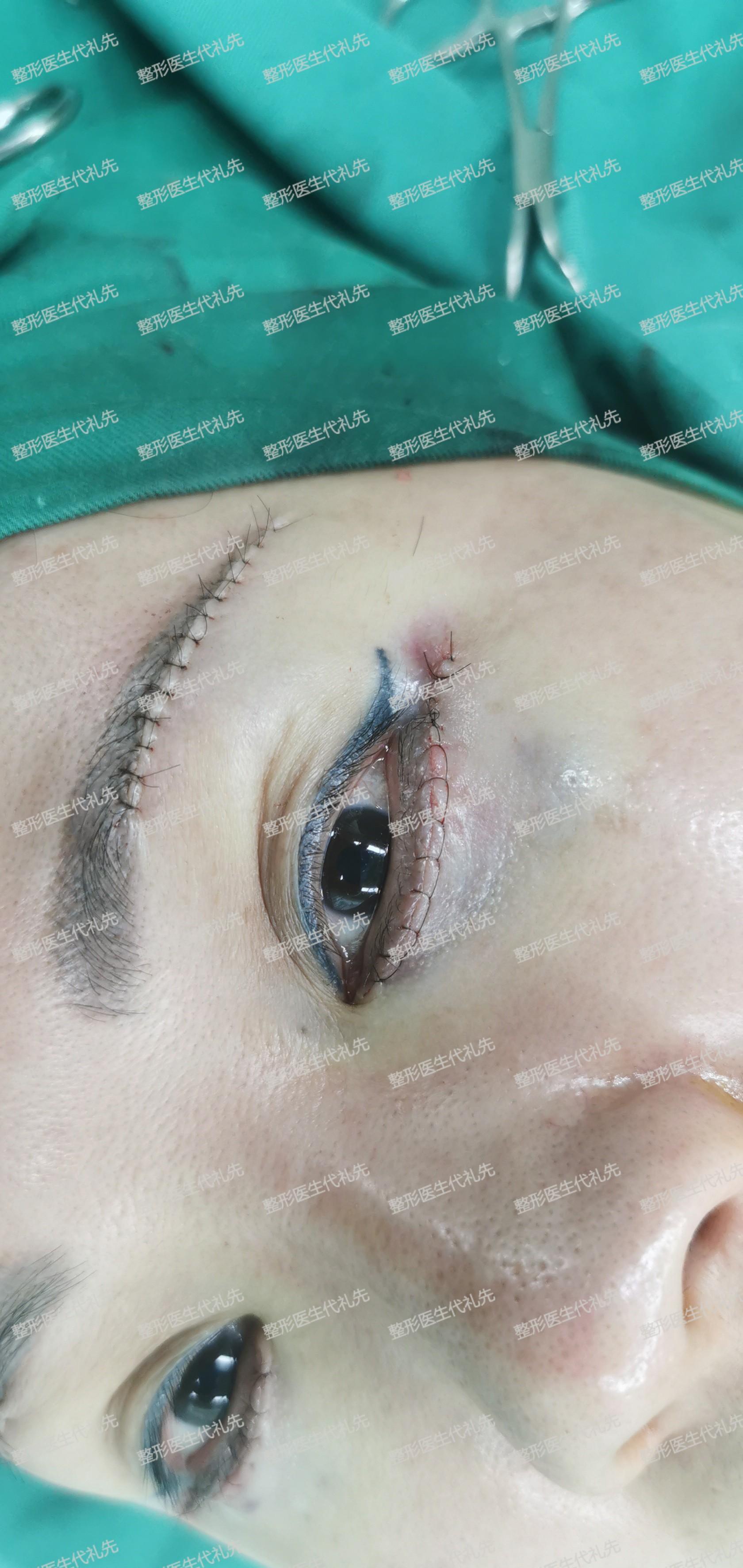 做提眉眼袋一周后,发在朋友圈的照片,收到的全是赞_戴医生_手术_眼睛