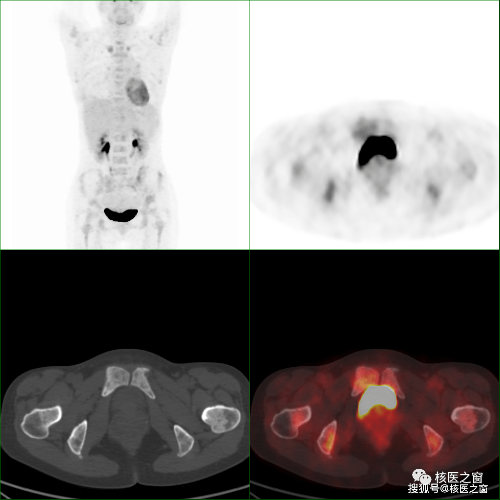 pet/ct在多發性骨髓瘤診療中獨具優勢_代謝_檢查_肋骨