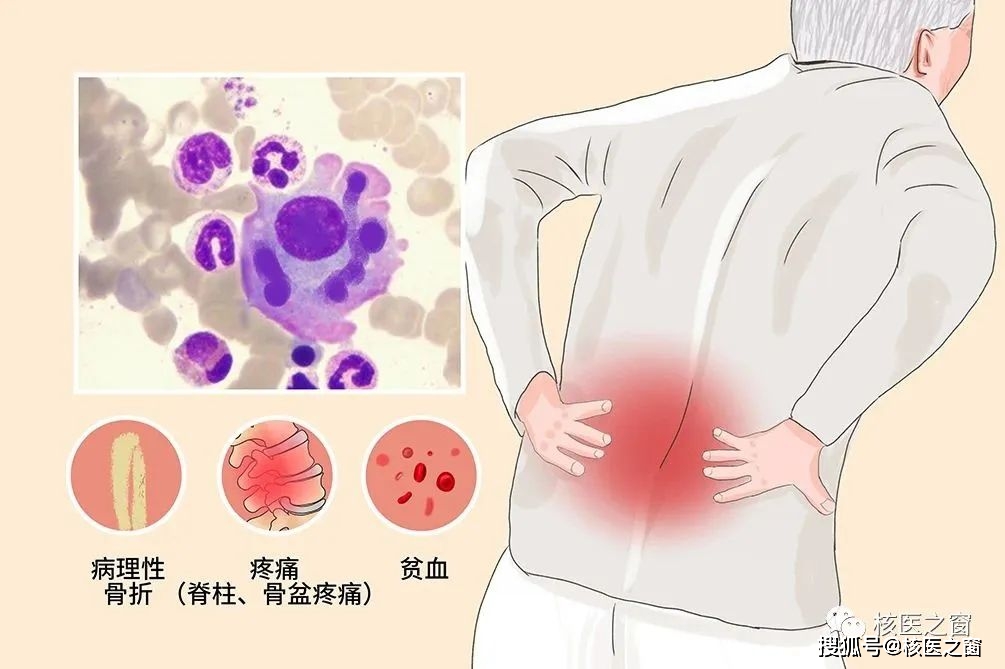 pet/ct在多發性骨髓瘤診療中獨具優勢_代謝_檢查_肋骨