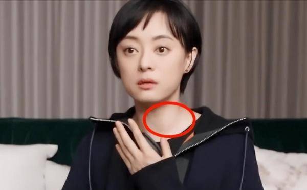 他的眼睛凸出来了,这可能是甲状腺机能亢进.