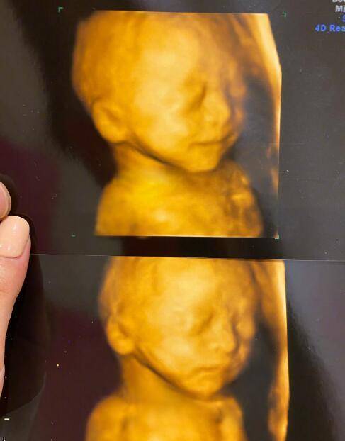 怀孕三个月宝宝彩超图图片
