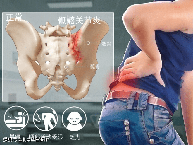 腰骶部疼痛的原因图片