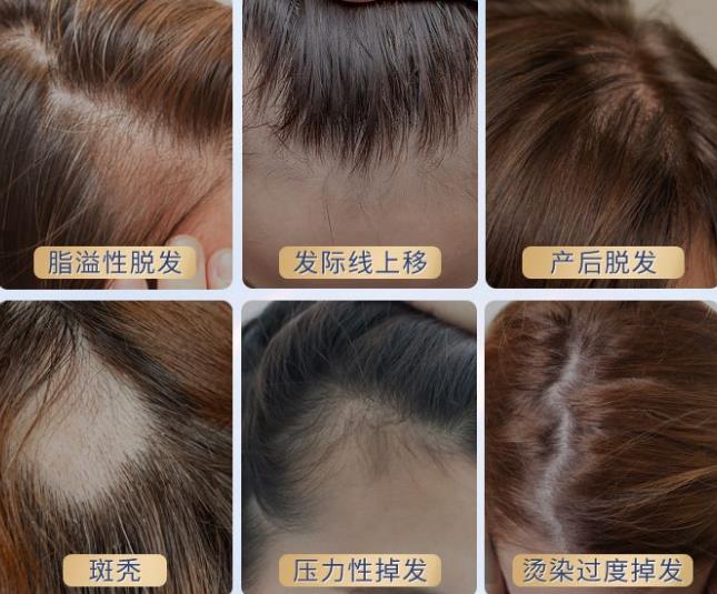 细软塌且脱发有救_效果_头皮_泡沫