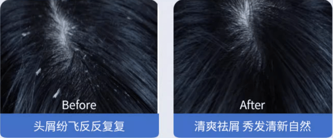 头痒头屑脱发严重怎样治疗|?分享好用止痒！（头痒皮屑多脱发怎么办）