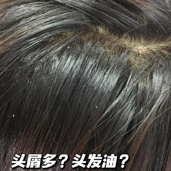 头发又痒又有头皮屑用什么洗发水好?柔顺去屑好点的洗发水推荐