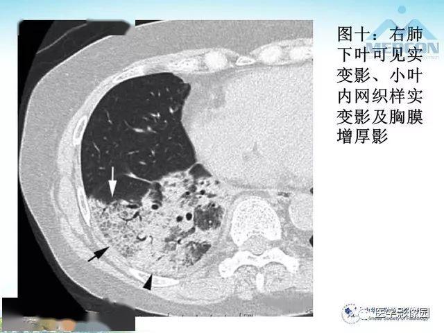 克雷伯桿菌肺炎ct表現