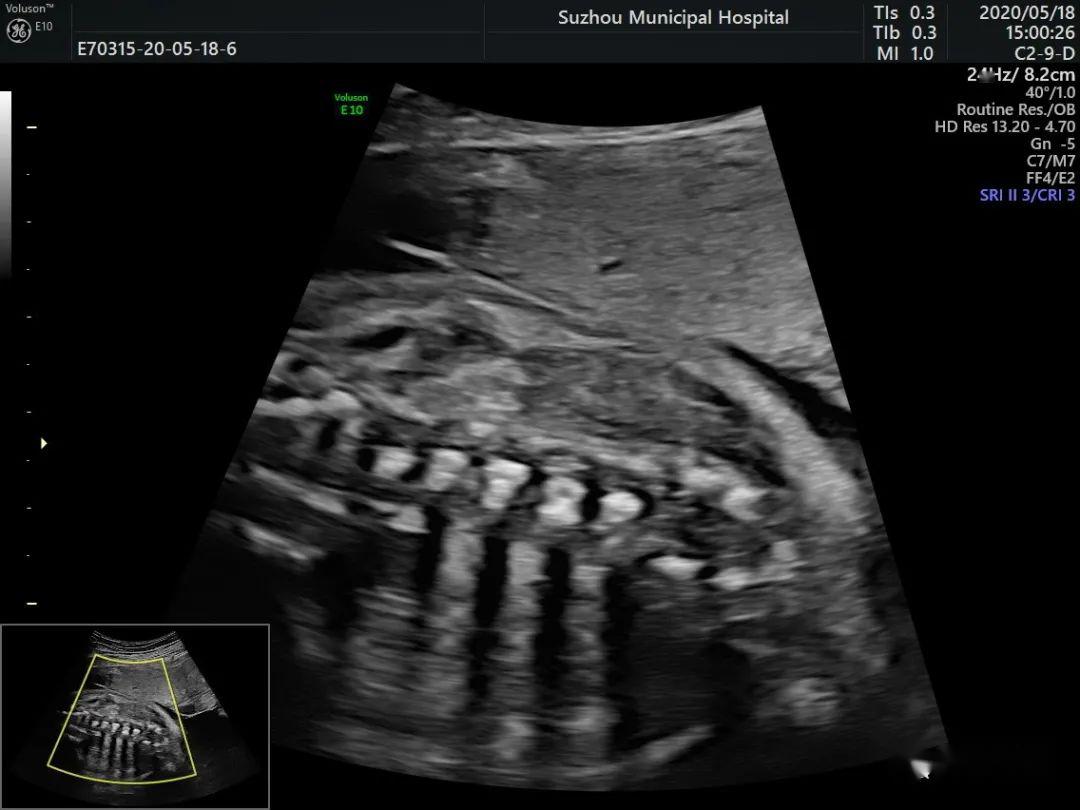 胎儿蝴蝶椎超声图片图片