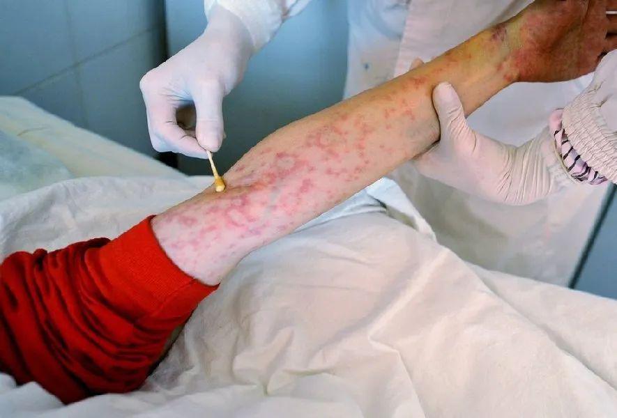 【高能预警】(相关体征)目前,艾滋病已经从一种致死性疾病变为一种