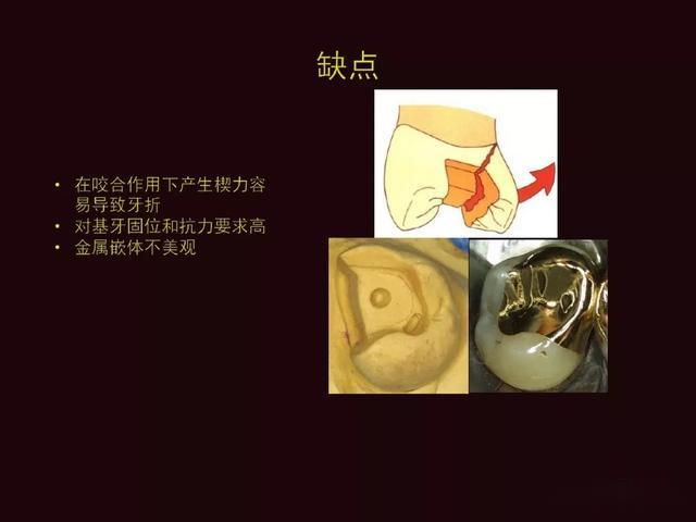 图文详解:嵌体or高嵌体_手机搜狐网