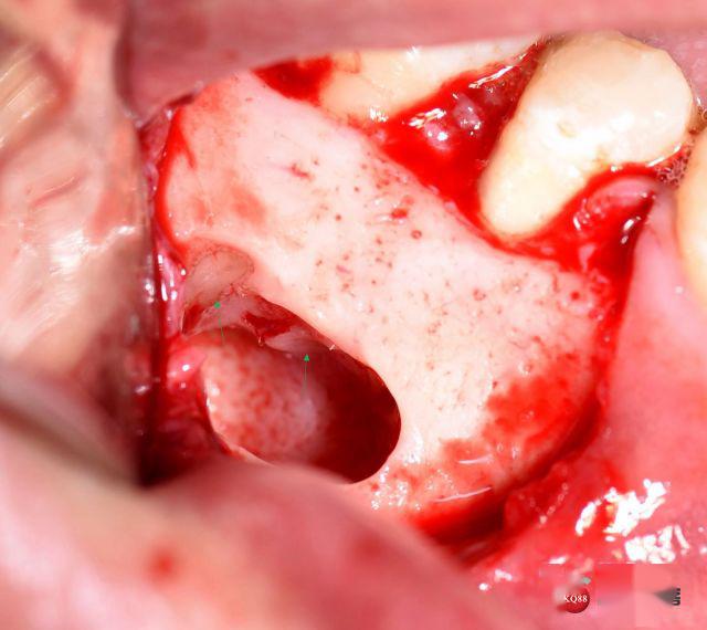 从微创到精准—后牙根尖囊肿摘除 根管倒充填手术