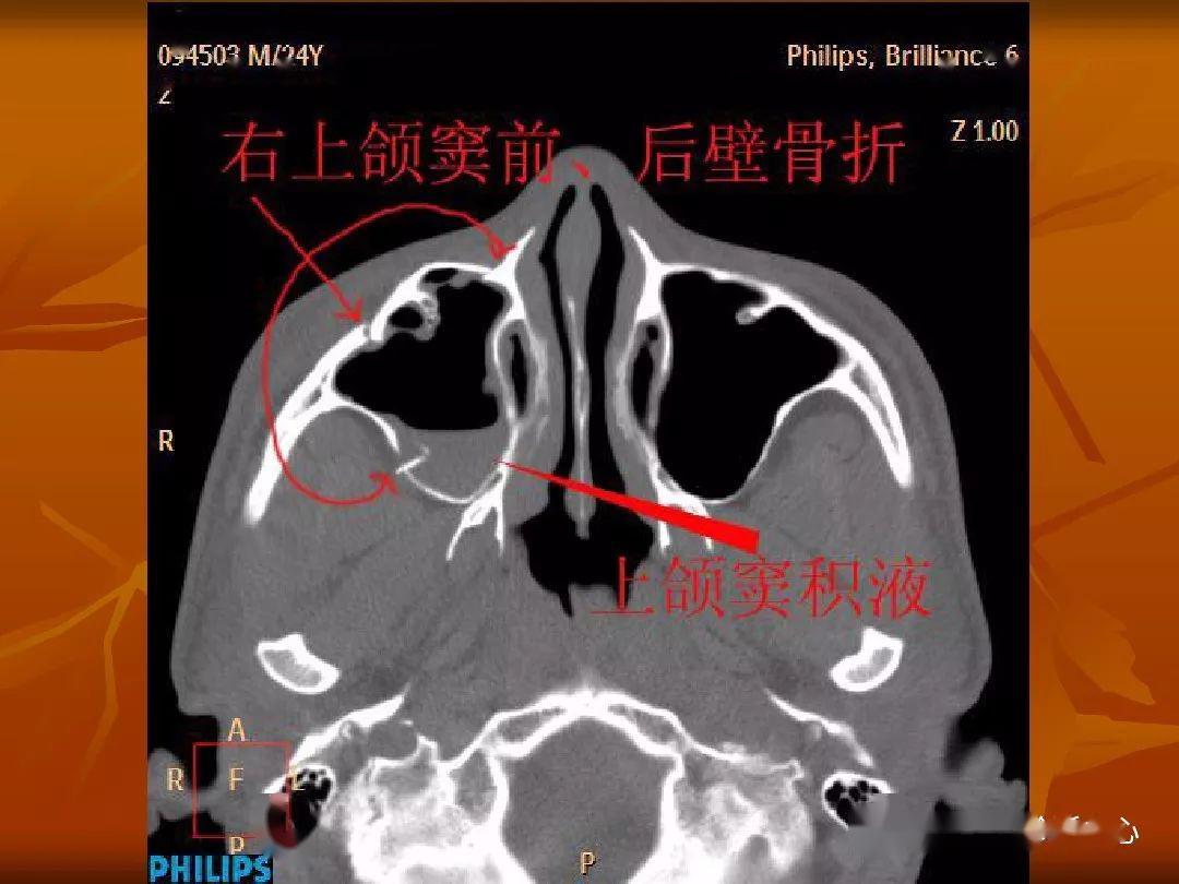 颅骨外伤性骨折ct诊断