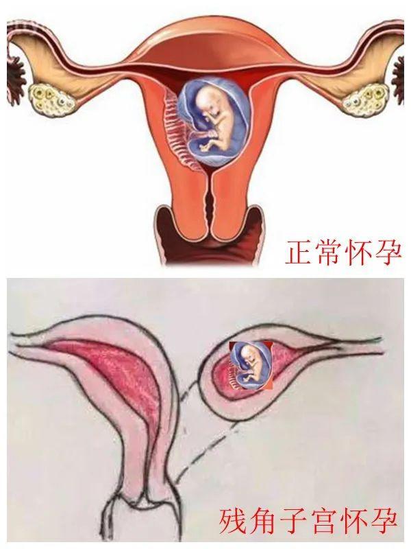 子宫右侧宫角图片图片