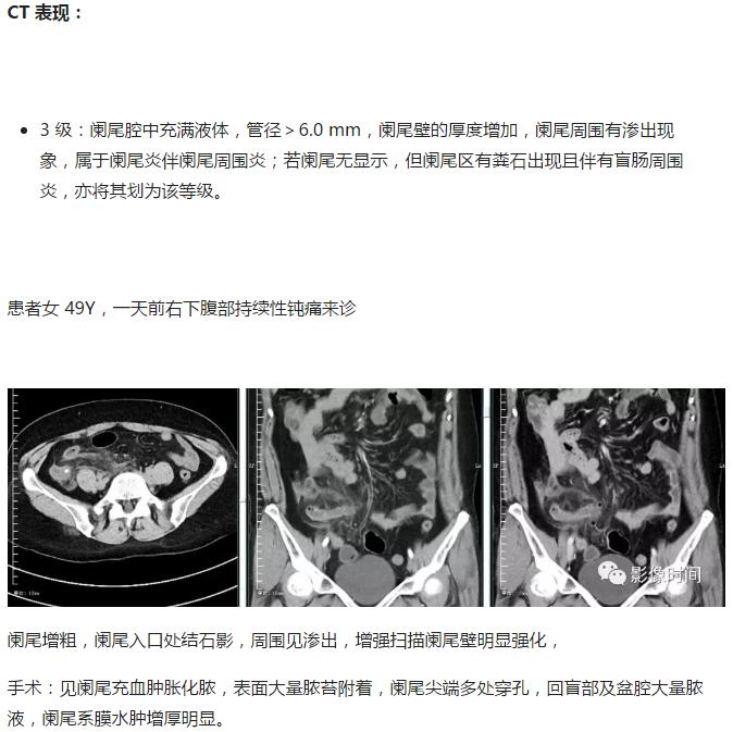 急性阑尾炎CT图片图片