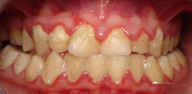 小孩子需要洗牙吗洗完牙会使牙缝变大吗洗牙可以使牙齿美白吗