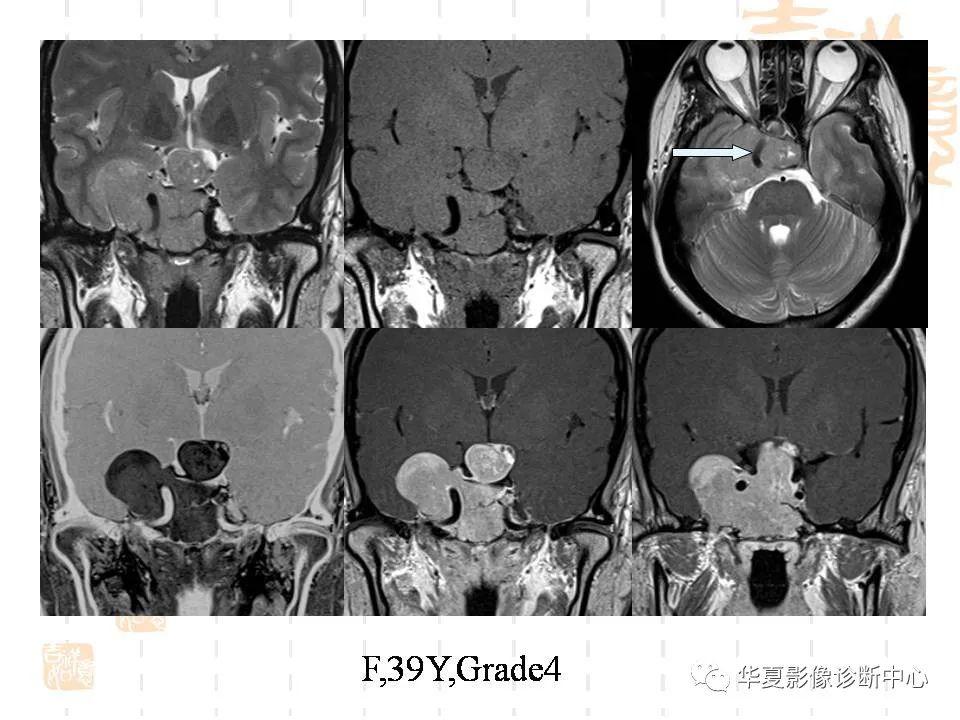 侵襲性垂體瘤的mri徵象