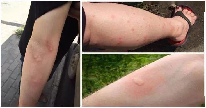 红肿,奇痒都算了,关键是一旦被蚊子咬了,还可能被传染 登革热,黄热病