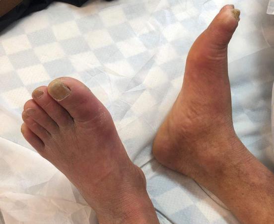 案例分享1例休克患者建立静脉通道的经验