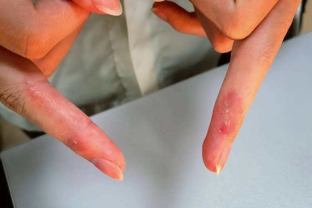 鱼鳞病大腿鸡皮疙瘩怎么祛(如果腿上有鸡皮疙瘩和鱼鳞皮肤怎么办?)