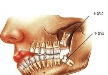 智齒的危害