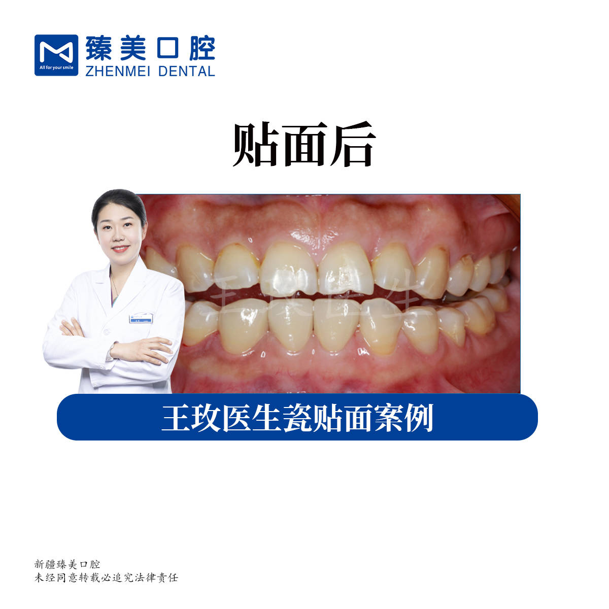 新疆臻美口腔:牙齿缺陷,贴面来弥补