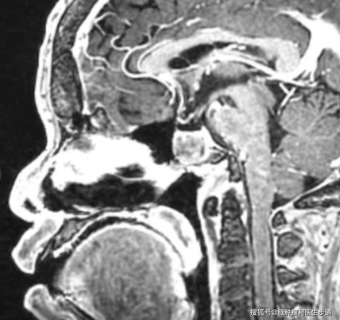 脑垂体瘤会影响长相吗 什么样的人容易垂体瘤