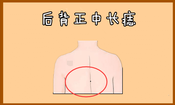 背部长痣的位置图解图片