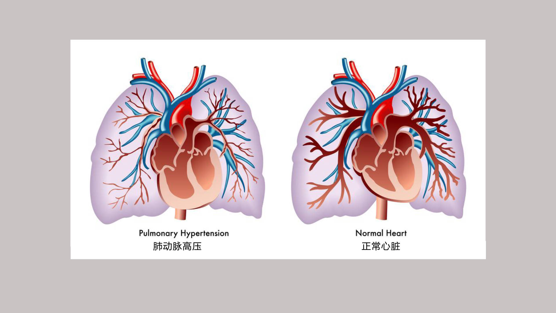 肺动脉位置图图片