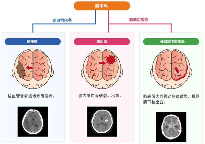 jmt日本干细胞干细胞如何治疗脑中风及脑中风的类型