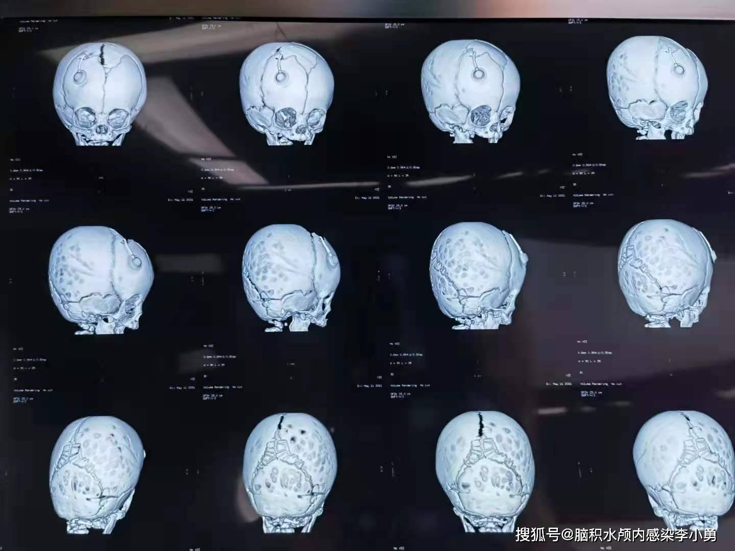 落日目脑积水图片