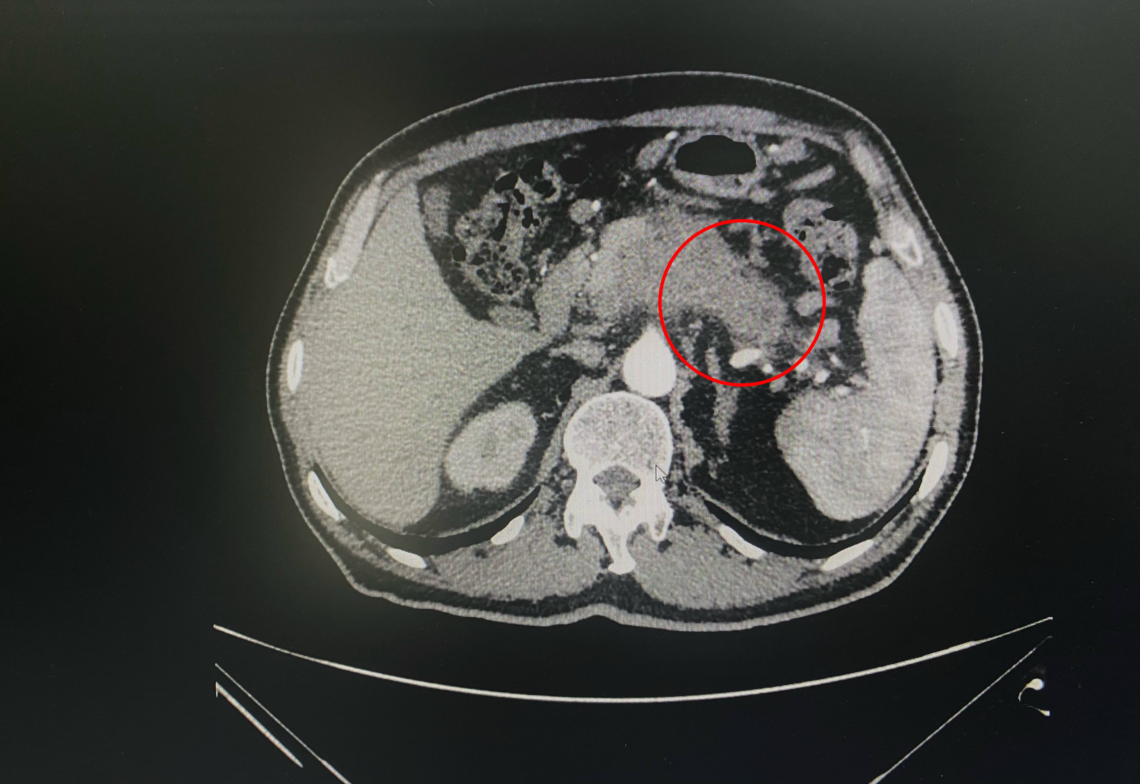 胰尾癌晚期图片