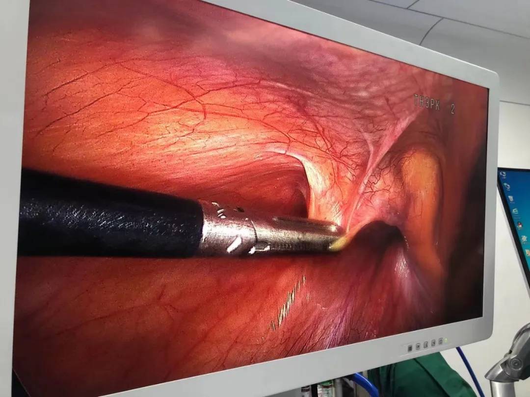 腹腔镜|杭州城东医院外科开展腹腔镜下微创手术治疗成人腹股沟疝