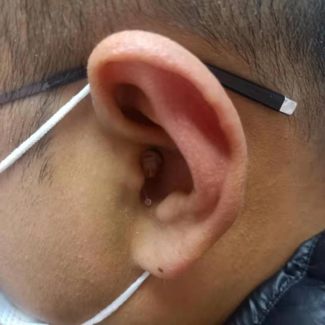 年轻人戴助听器的危害 戴助听器的人算残疾吗