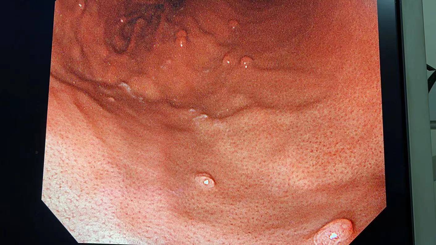 腺性瘤息肉手术后图片图片