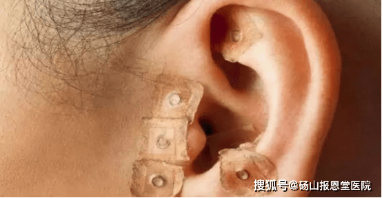 针灸如何治疗神经衰弱针灸治疗神经衰弱要取哪里的穴位