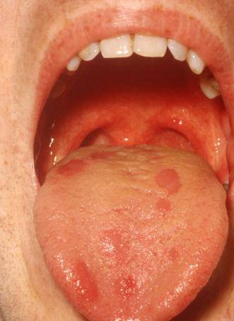 口腔溃疡 皮肤问题